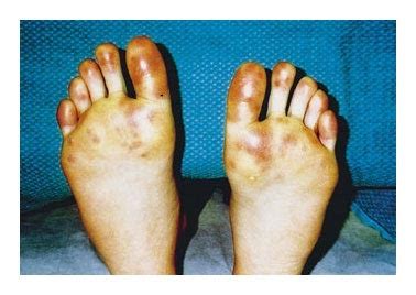 hot feet|hot feet syndrome nhs.